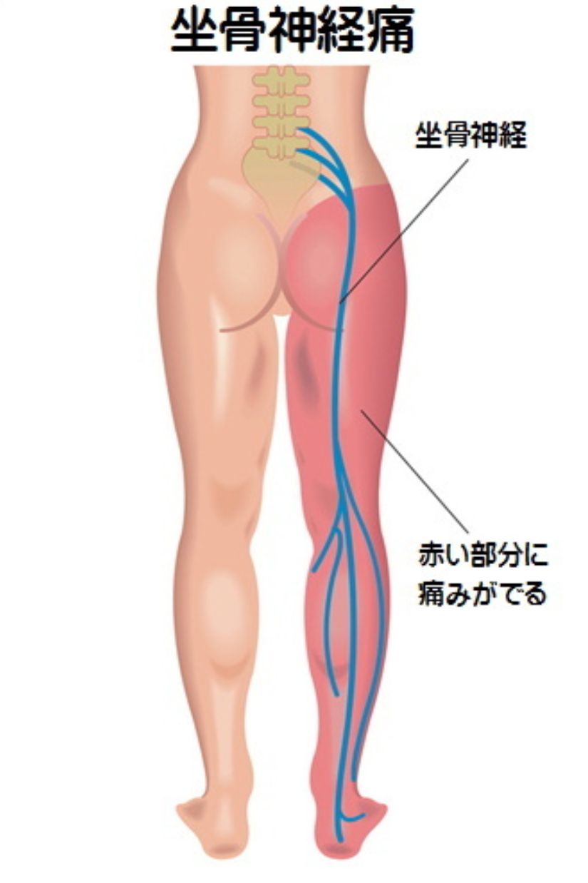 湿布 坐骨 神経痛